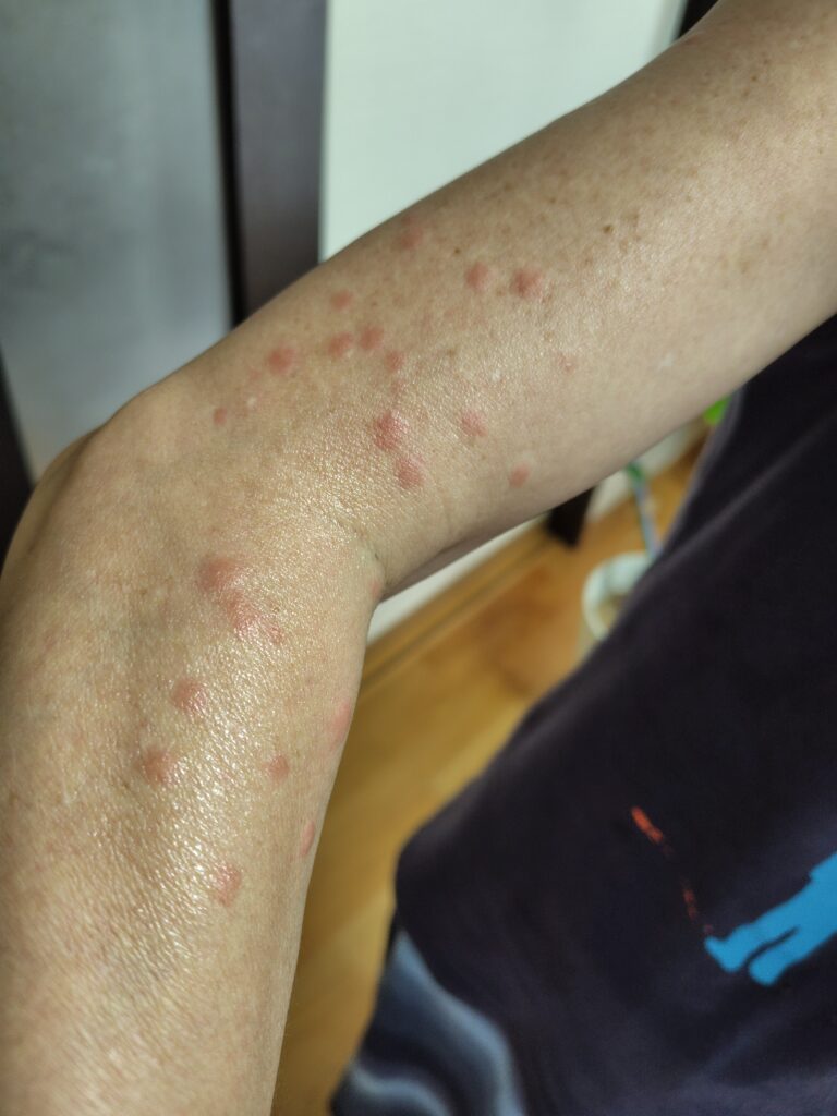 毛虫にさされた直後です